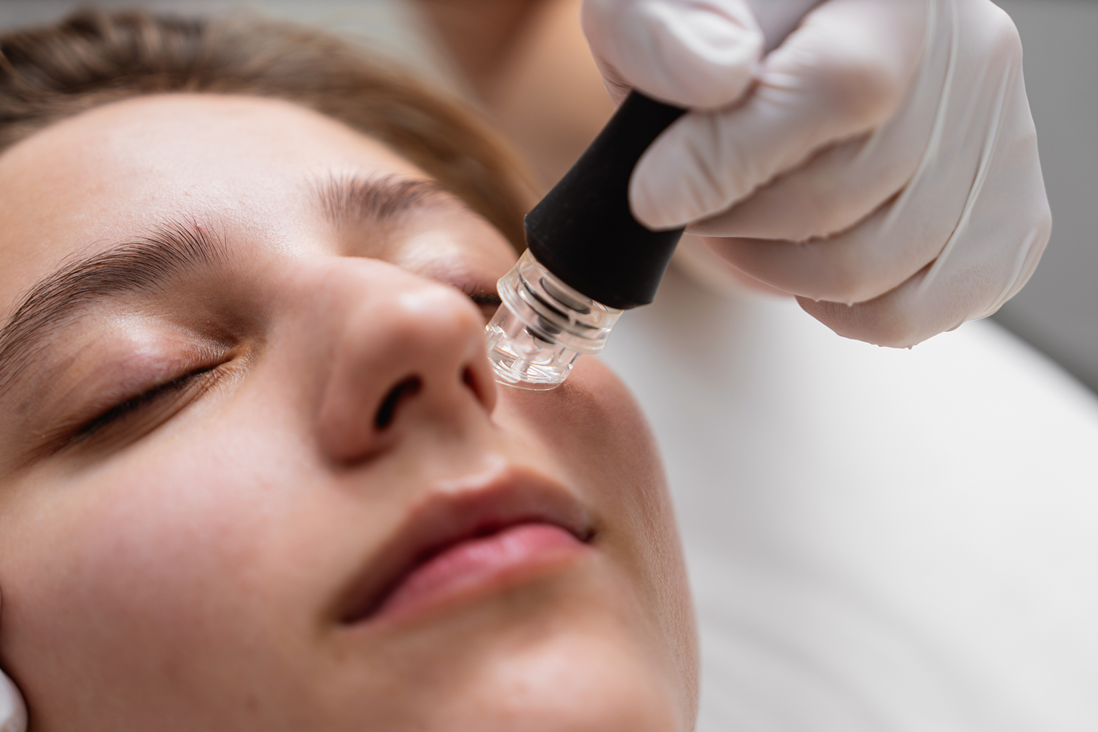 Microneedling servicios estética